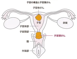 子宮の構造と子宮頸がん